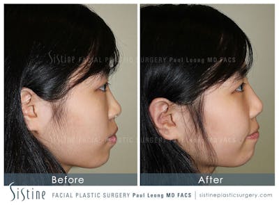 Nose Before & After Gallery - Patient 4890073 - Image 4