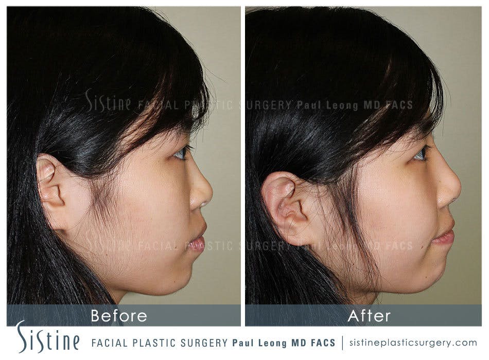 Nose Before & After Gallery - Patient 4890073 - Image 4