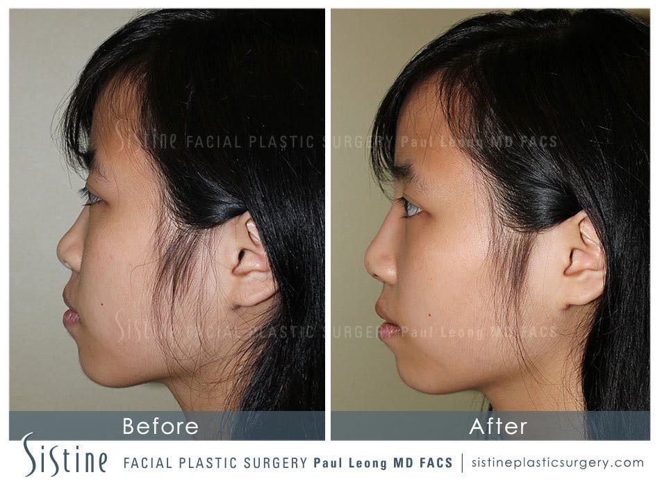 Nose Before & After Gallery - Patient 4890073 - Image 5