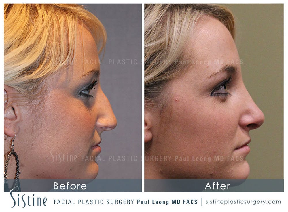 Nose Before & After Gallery - Patient 4890074 - Image 2