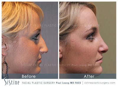 Nose Before & After Gallery - Patient 4890074 - Image 2