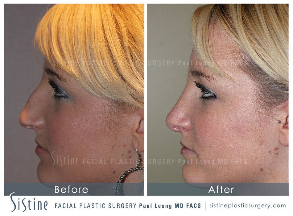 Nose Before & After Gallery - Patient 4890074 - Image 3