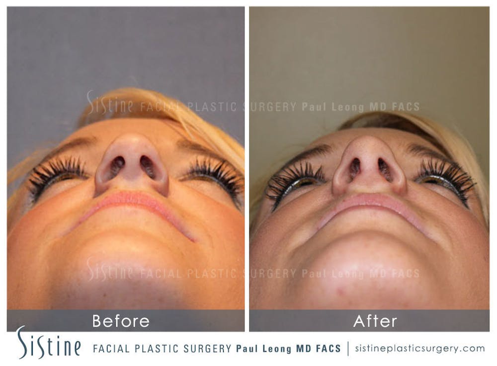 Nose Before & After Gallery - Patient 4890074 - Image 4