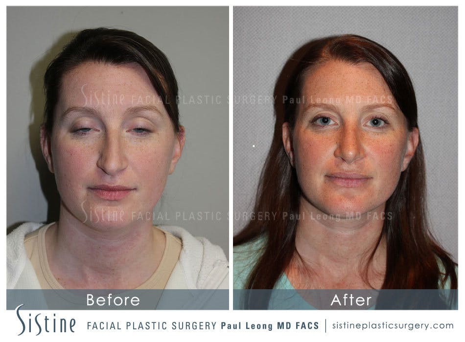 Nose Before & After Gallery - Patient 4890078 - Image 1
