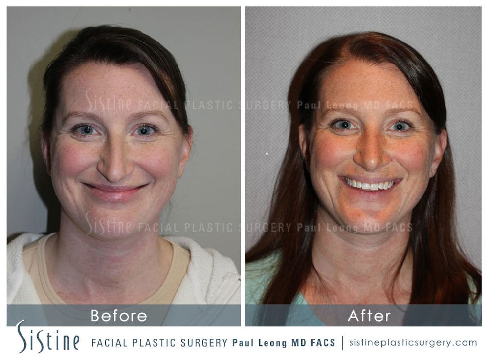 Nose Before & After Gallery - Patient 4890078 - Image 2