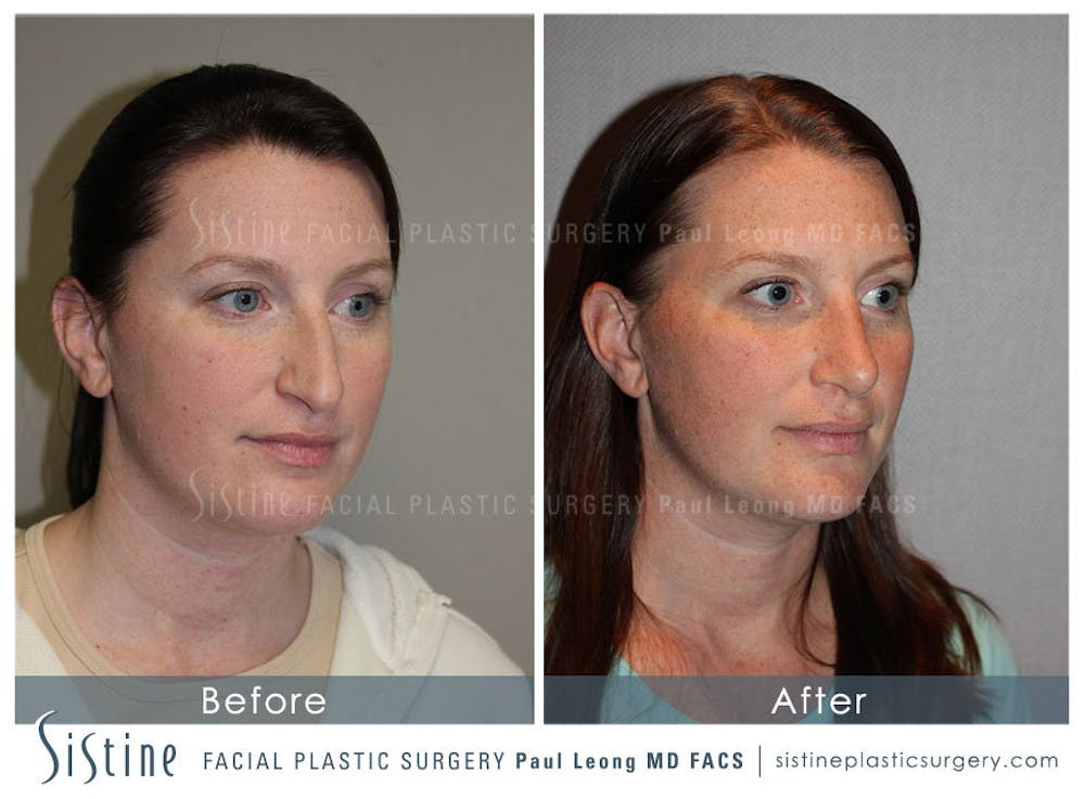 Nose Before & After Gallery - Patient 4890078 - Image 3