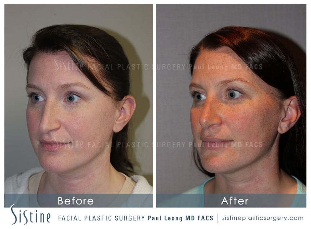 Nose Before & After Gallery - Patient 4890078 - Image 4