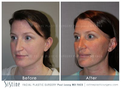 Nose Before & After Gallery - Patient 4890078 - Image 4