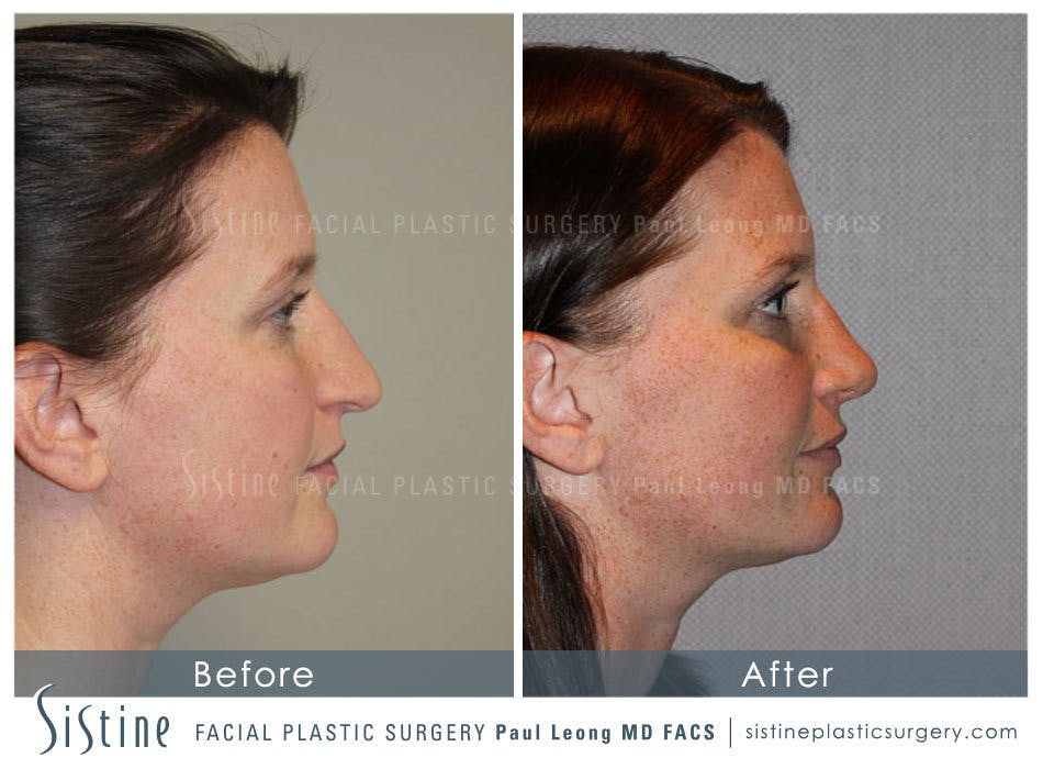 Nose Before & After Gallery - Patient 4890078 - Image 5