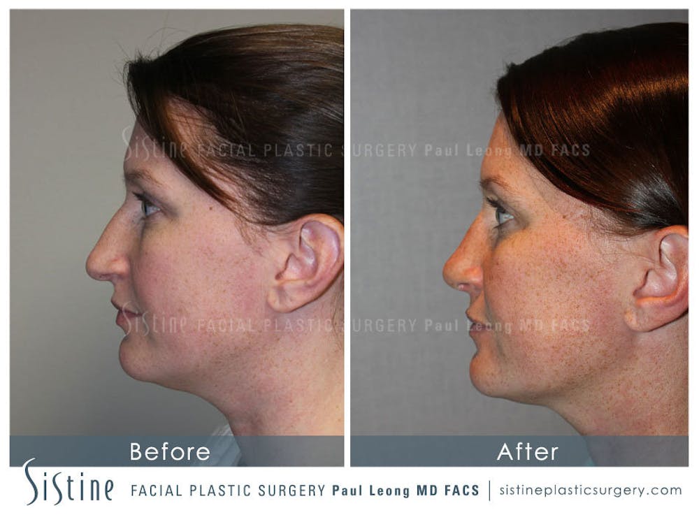 Nose Before & After Gallery - Patient 4890078 - Image 7