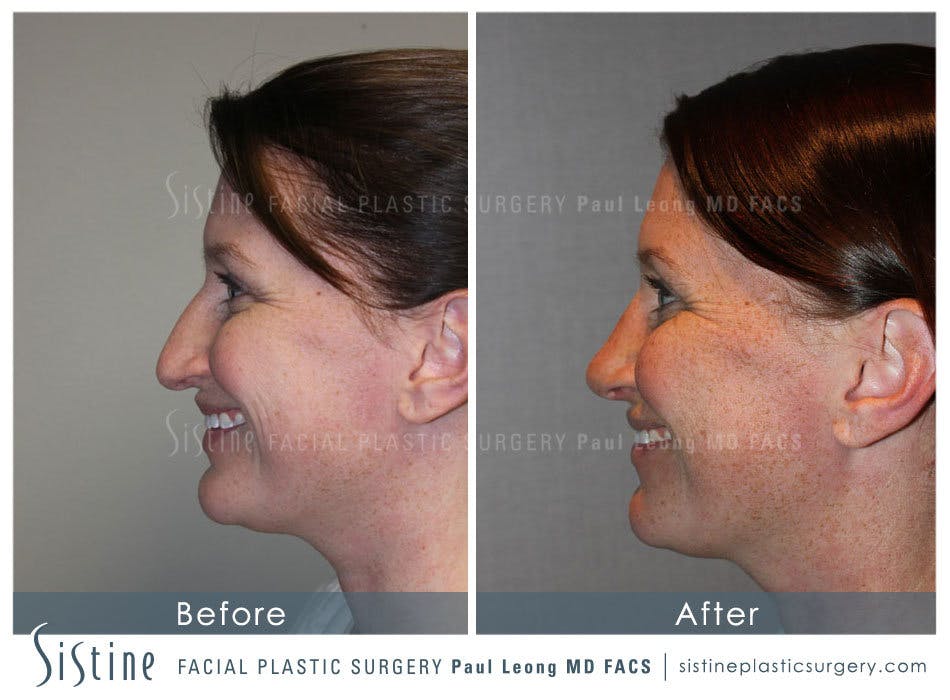 Nose Before & After Gallery - Patient 4890078 - Image 8