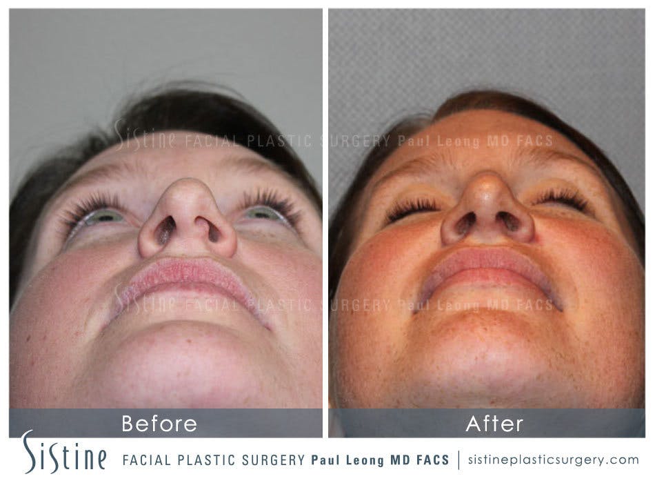 Nose Before & After Gallery - Patient 4890078 - Image 9