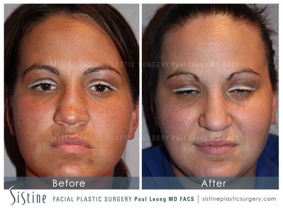 Nose Before & After Gallery - Patient 4890081 - Image 1