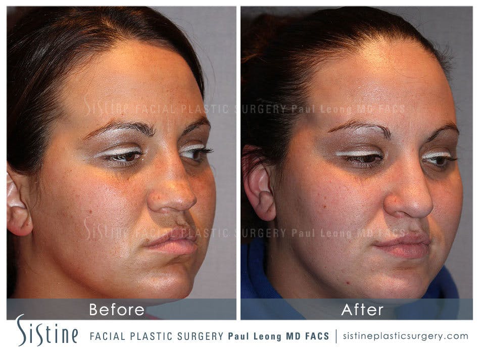 Nose Before & After Gallery - Patient 4890081 - Image 2