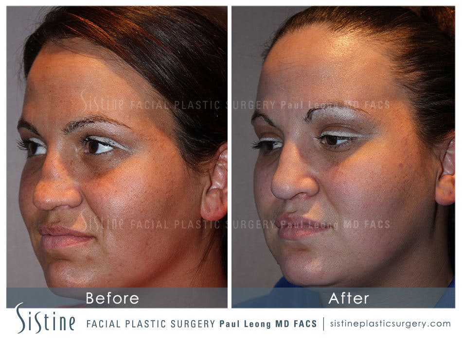 Nose Before & After Gallery - Patient 4890081 - Image 3