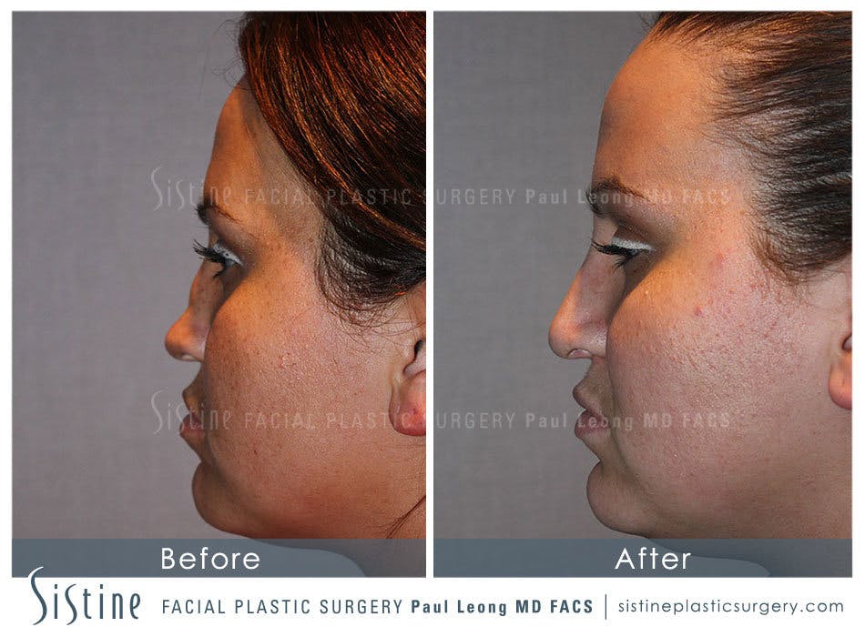 Nose Before & After Gallery - Patient 4890081 - Image 5