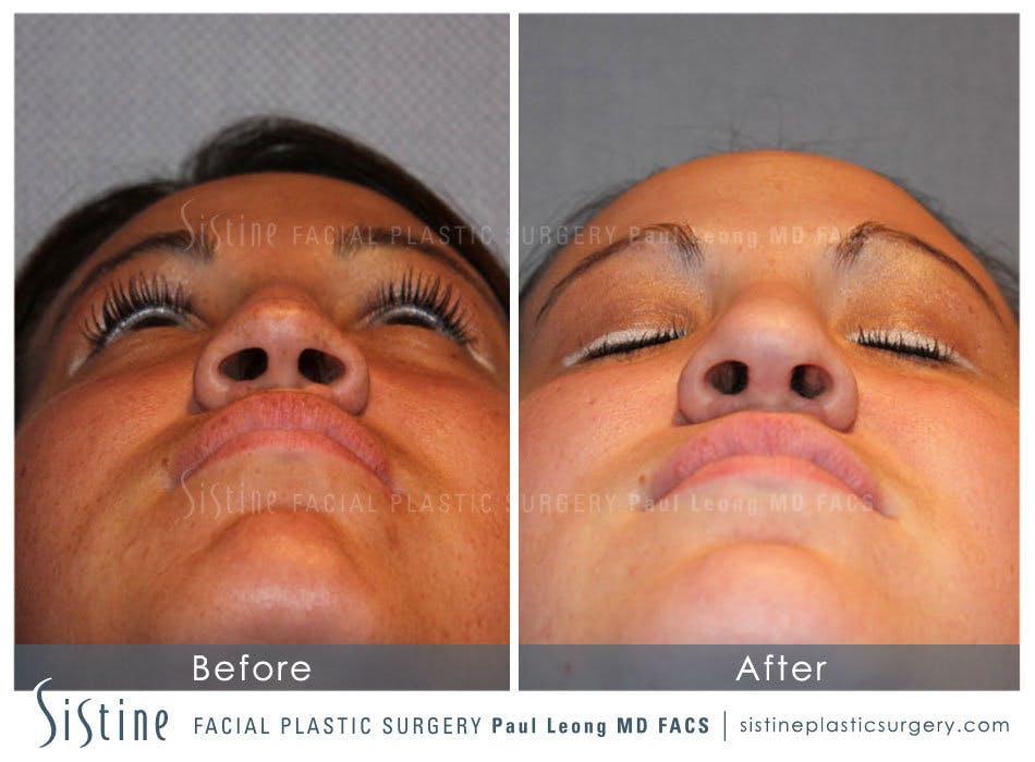 Nose Before & After Gallery - Patient 4890081 - Image 6