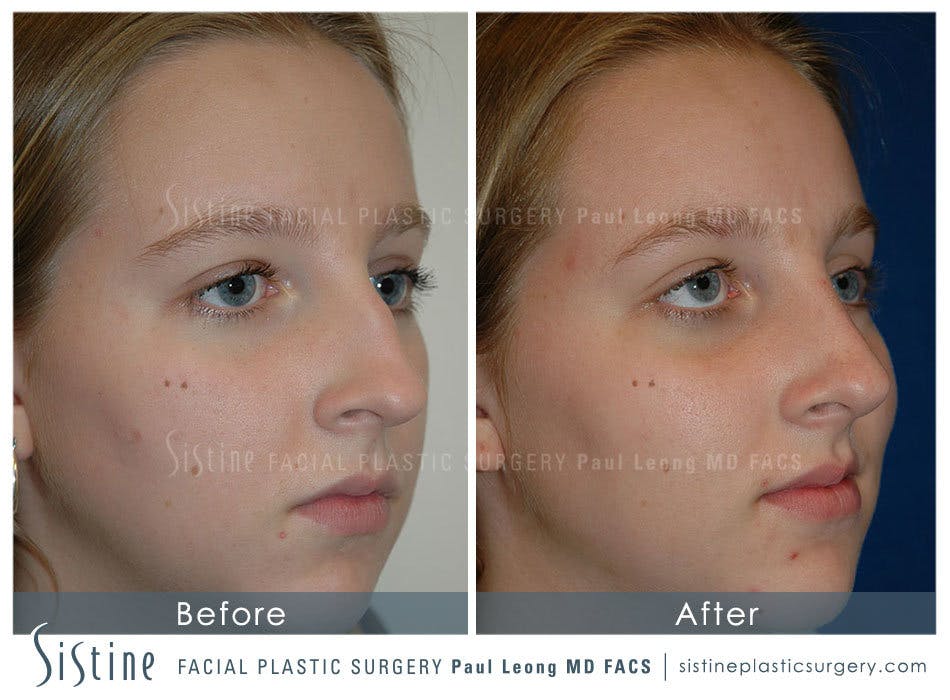 Nose Before & After Gallery - Patient 4890084 - Image 2