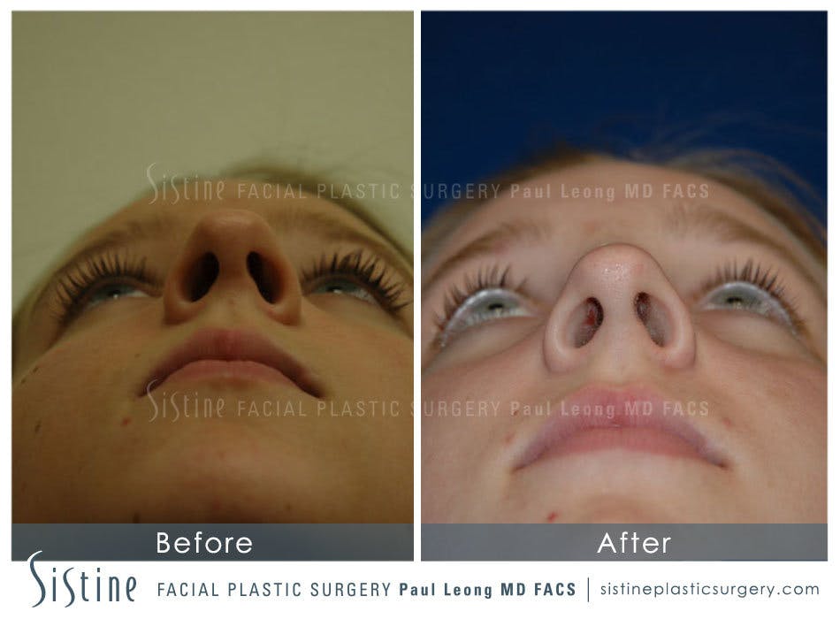 Nose Before & After Gallery - Patient 4890084 - Image 3