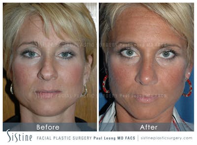 Nose Before & After Gallery - Patient 4890111 - Image 1