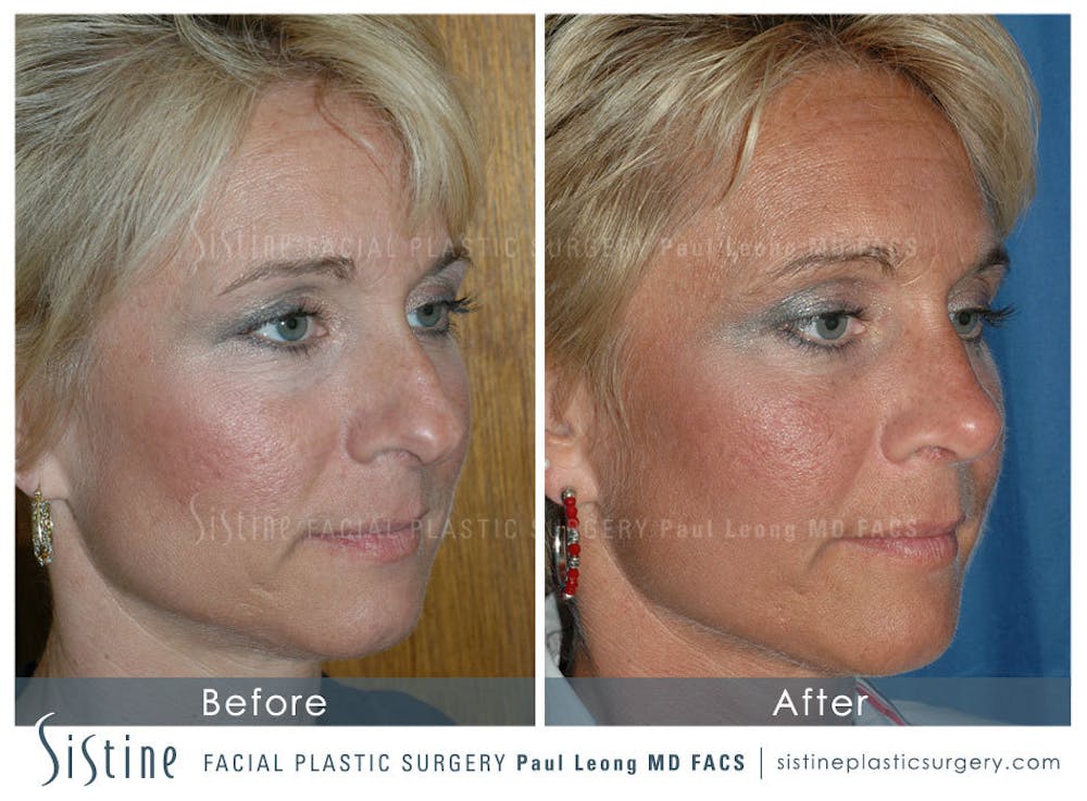 Nose Before & After Gallery - Patient 4890111 - Image 2
