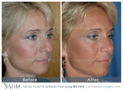Nose Before & After Gallery - Patient 4890111 - Image 2