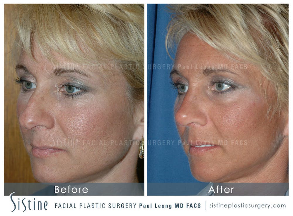 Nose Before & After Gallery - Patient 4890111 - Image 3
