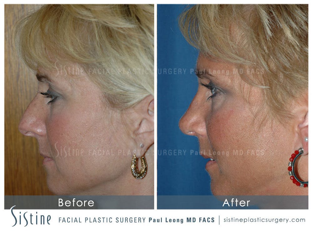 Nose Before & After Gallery - Patient 4890111 - Image 5