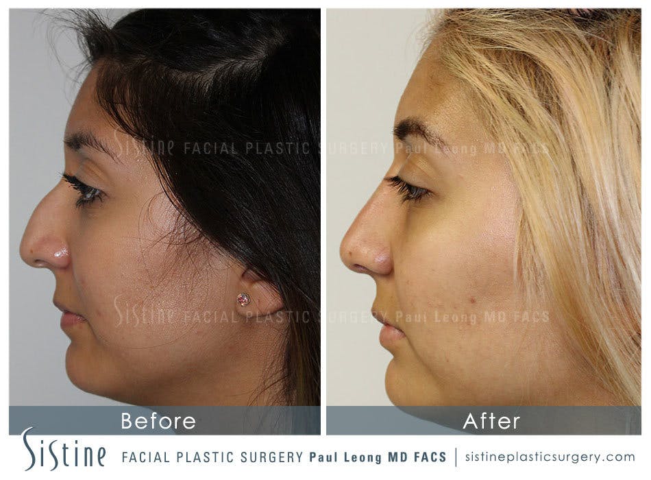 Nose Before & After Gallery - Patient 4890128 - Image 1