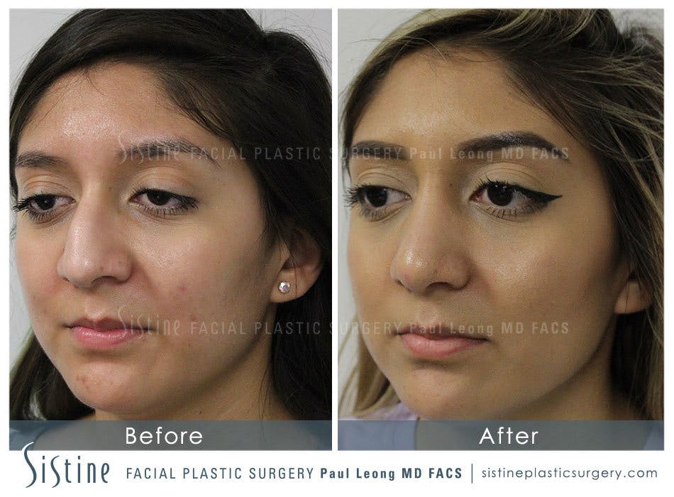 Nose Before & After Gallery - Patient 4890128 - Image 3