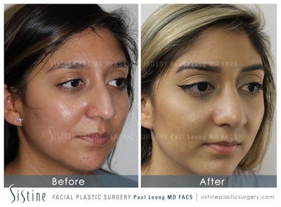 Nose Before & After Gallery - Patient 4890128 - Image 4