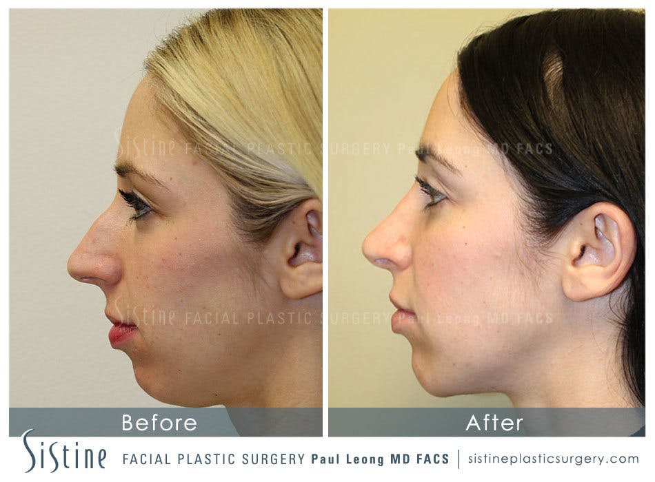 Nose Before & After Gallery - Patient 4890131 - Image 1