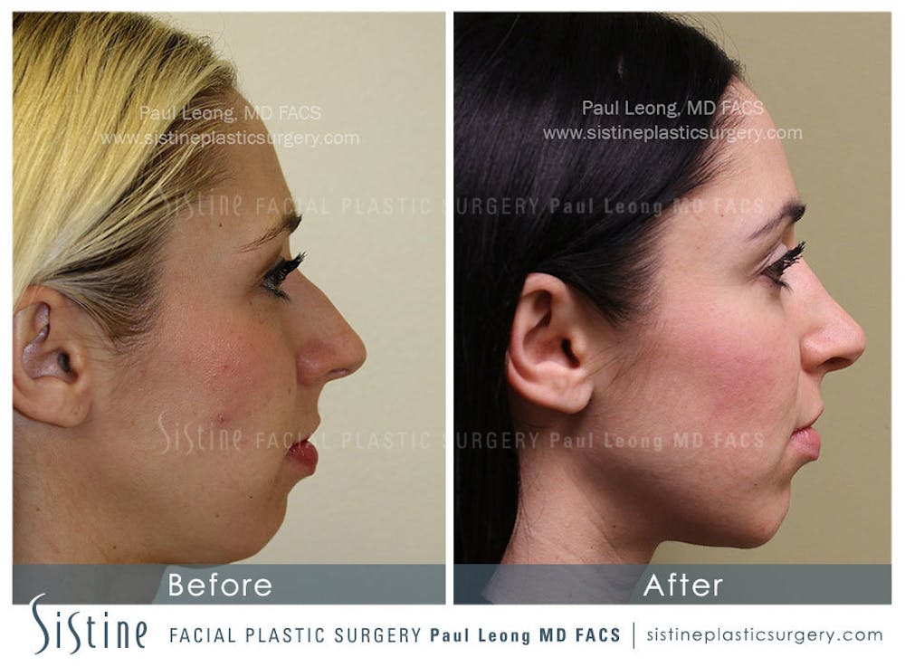 Nose Before & After Gallery - Patient 4890131 - Image 2