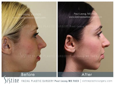 Nose Before & After Gallery - Patient 4890131 - Image 2