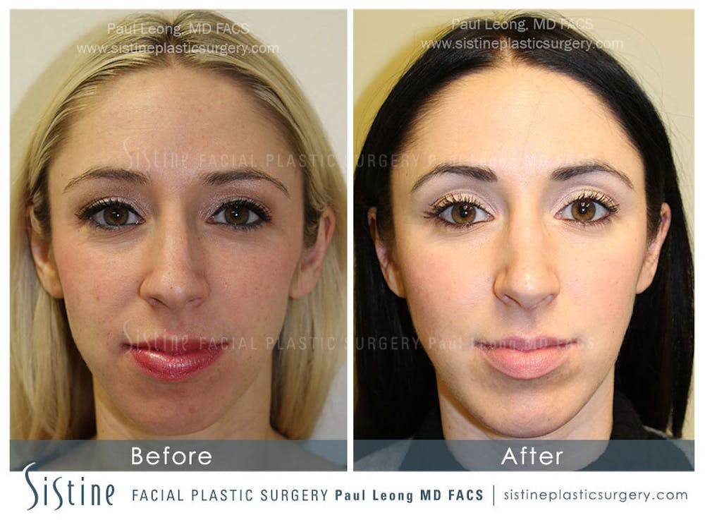 Nose Before & After Gallery - Patient 4890131 - Image 3