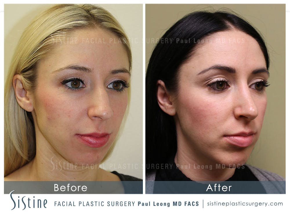 Nose Before & After Gallery - Patient 4890131 - Image 4