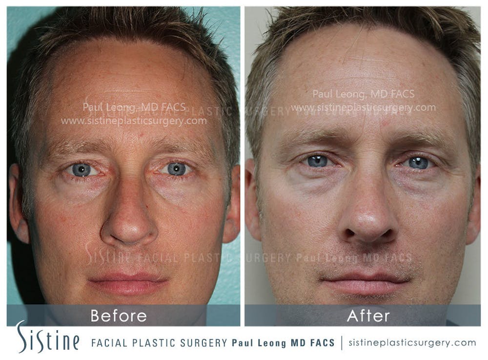 Nose Before & After Gallery - Patient 4890202 - Image 1