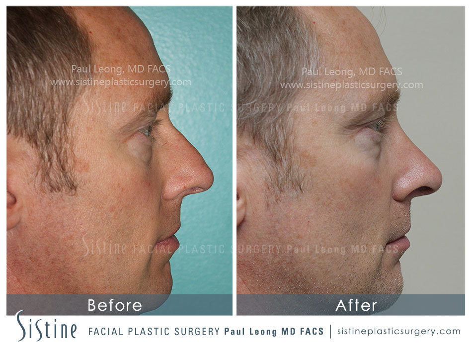 Patient 4890202 | Nose Gallery | Leong Aesthetics