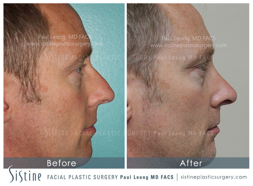 Nose Before & After Gallery - Patient 4890202 - Image 2