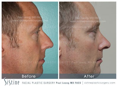 Nose Before & After Gallery - Patient 4890202 - Image 2