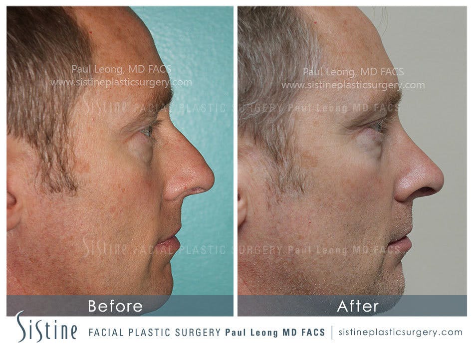 Nose Before & After Gallery - Patient 4890202 - Image 2