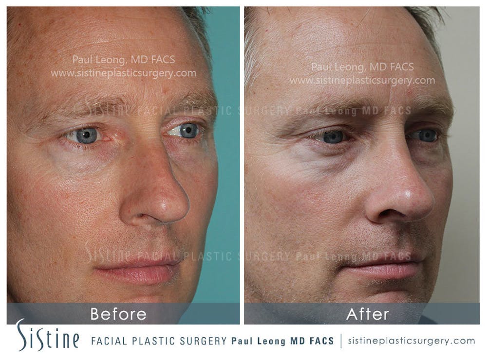 Nose Before & After Gallery - Patient 4890202 - Image 3