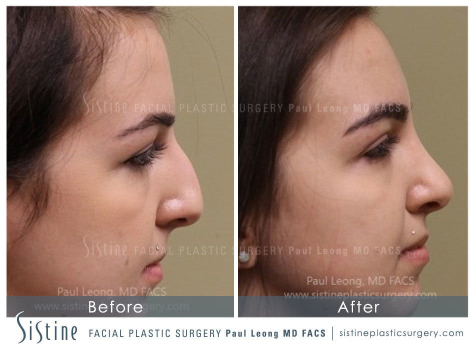Nose Before & After Gallery - Patient 4890341 - Image 1
