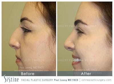 Nose Before & After Gallery - Patient 4890341 - Image 2