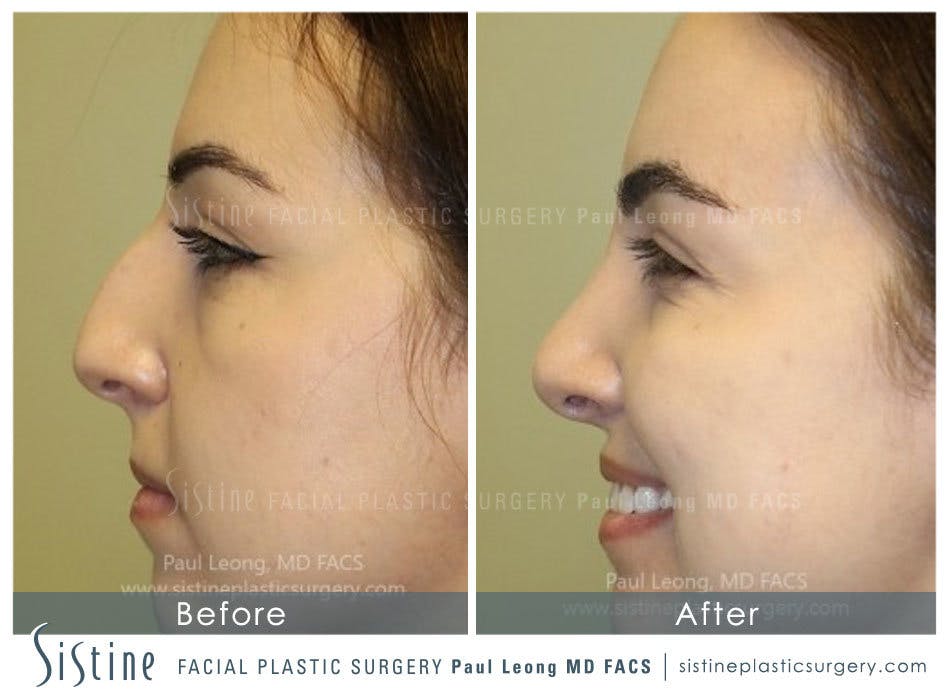 Nose Before & After Gallery - Patient 4890341 - Image 2