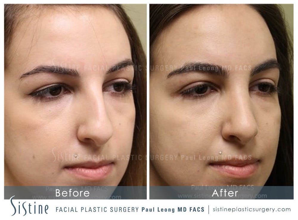 Nose Before & After Gallery - Patient 4890341 - Image 3