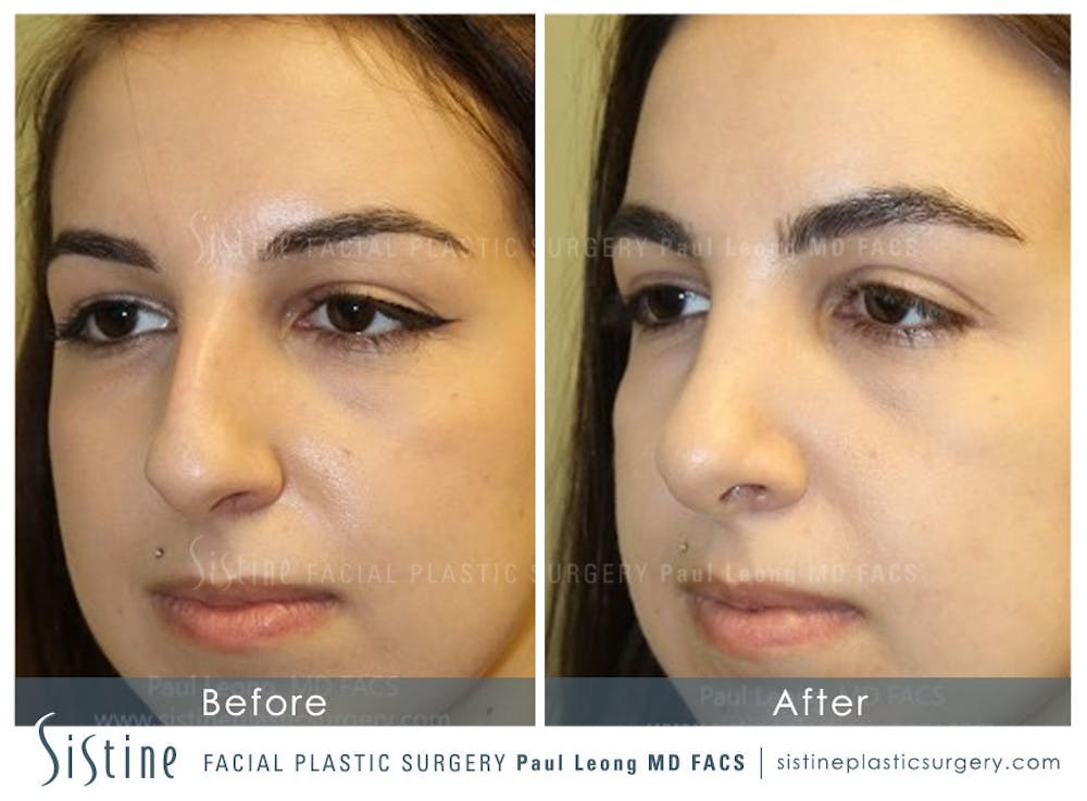Nose Before & After Gallery - Patient 4890341 - Image 4