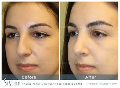 Nose Before & After Gallery - Patient 4890341 - Image 4