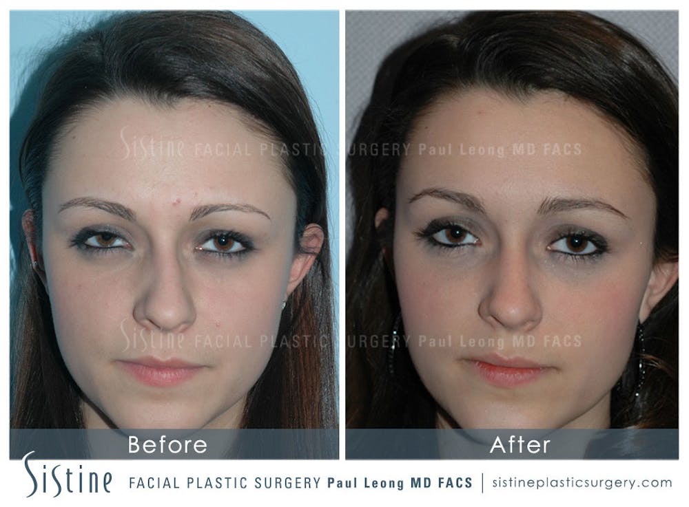 Dermal Fillers Before & After Gallery - Patient 4890535 - Image 1
