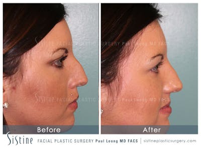 Dermal Fillers Before & After Gallery - Patient 4890580 - Image 1